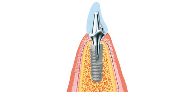 implant1a
